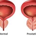 Prostatitis